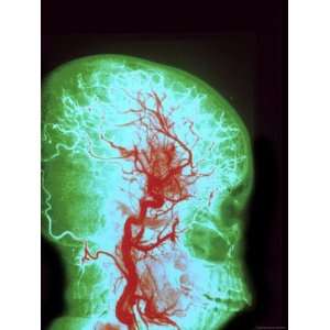  Digitized Angiogram Human Head, Vessels Photographic 